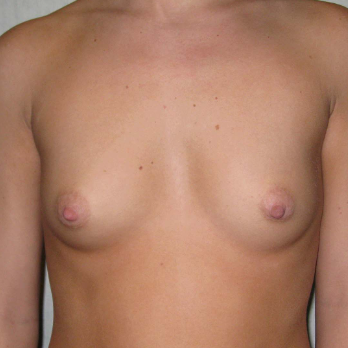 Front view of patient before Breast Augmentation Surgery