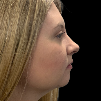 preservation-rhinoplasty-after