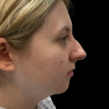 preservation-rhinoplasty-before