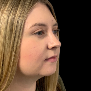 preservation-rhinoplasty-after