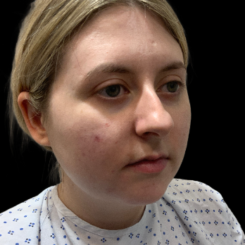 preservation-rhinoplasty-before