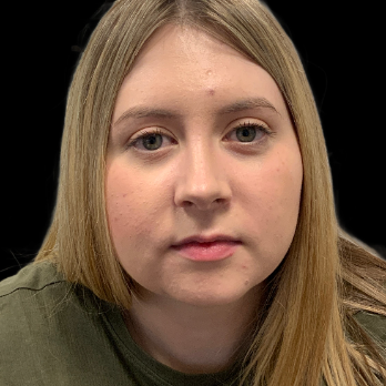 preservation-rhinoplasty-after