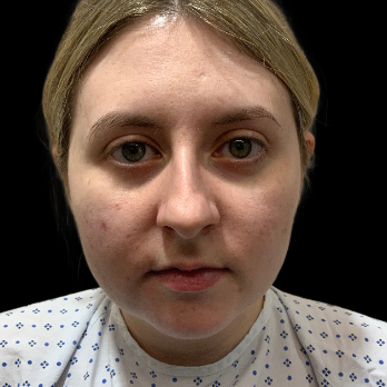 preservation-rhinoplasty-before