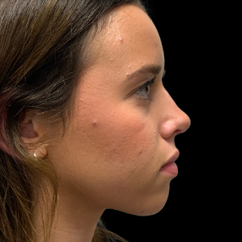 preservation-rhinoplasty-after