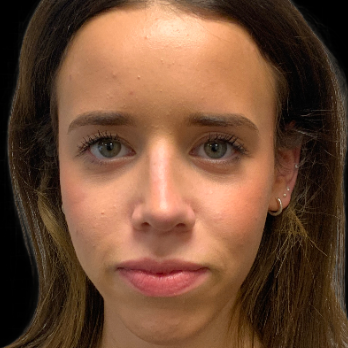 preservation-rhinoplasty-after