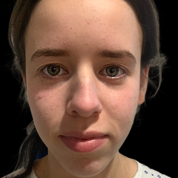 preservation-rhinoplasty-before