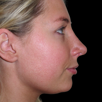 rhinoplasty-after
