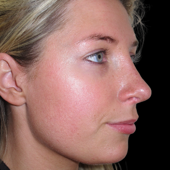 rhinoplasty-after
