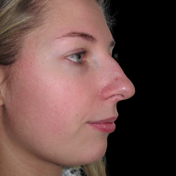 rhinoplasty-before