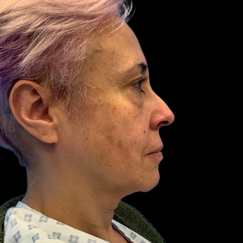 Stem cell facelift surgery patient before surgery