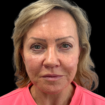 Stem cell facelift surgery patient after surgery