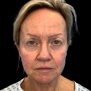 Stem cell facelift surgery patient before surgery