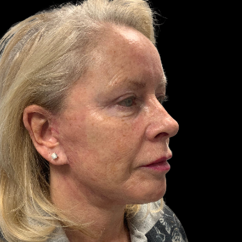 Stem cell facelift surgery patient after surgery