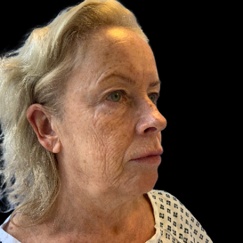 Stem cell facelift surgery patient before surgery