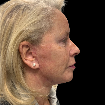 Stem cell facelift surgery patient after surgery