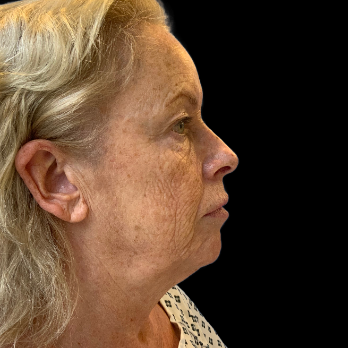 Stem cell facelift surgery patient before surgery