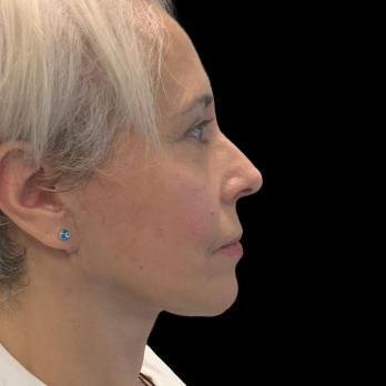 Stem cell facelift surgery patient after surgery