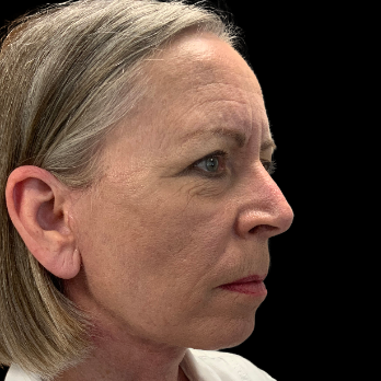 Stem cell facelift surgery patient after surgery