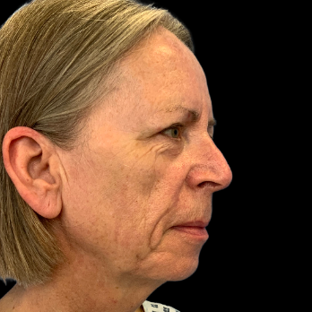 Stem cell facelift surgery patient before surgery