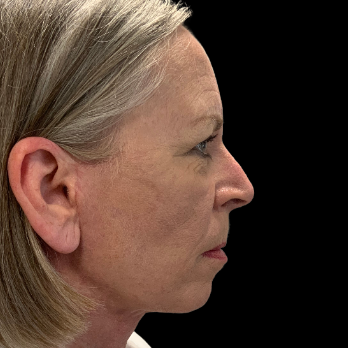 Stem cell facelift surgery patient after surgery