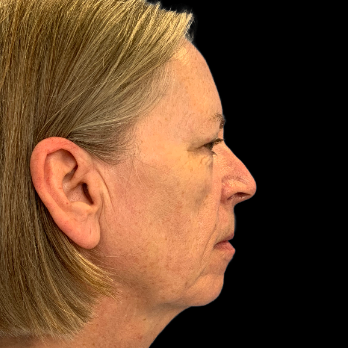 Stem cell facelift surgery patient before surgery