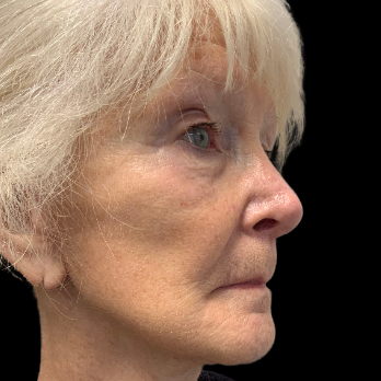 Stem cell facelift surgery patient after surgery