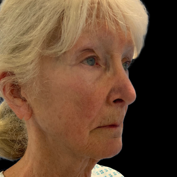 Stem cell facelift surgery patient before surgery