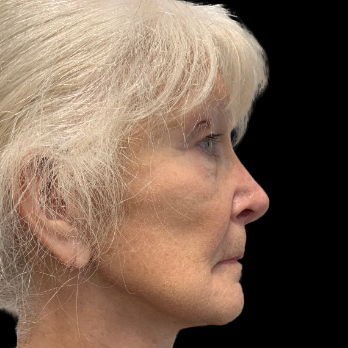 Stem cell facelift surgery patient after surgery
