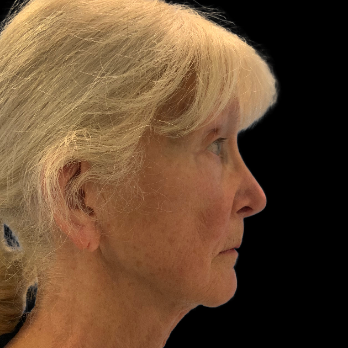 Stem cell facelift surgery patient before surgery