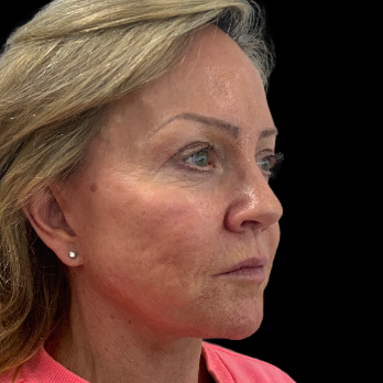 Stem cell facelift surgery patient after surgery