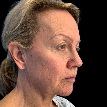 Stem cell facelift surgery patient before surgery