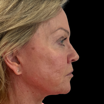 Stem cell facelift surgery patient after surgery