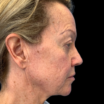 Stem cell facelift surgery patient before surgery