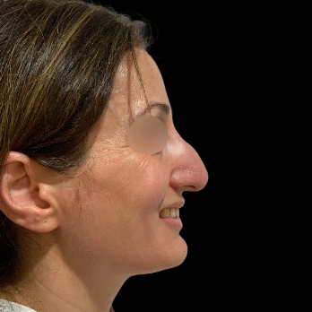 ultrasonic-rhinoplasty-before