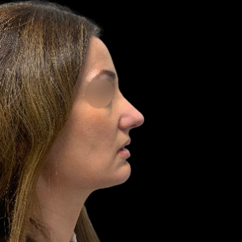 ultrasonic-rhinoplasty-after