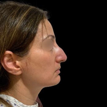 ultrasonic-rhinoplasty-before
