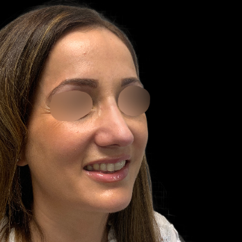 ultrasonic-rhinoplasty-after