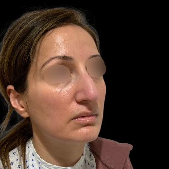 ultrasonic-rhinoplasty-before