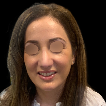 ultrasonic-rhinoplasty-after