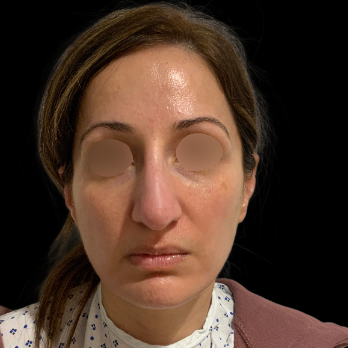 ultrasonic-rhinoplasty-before