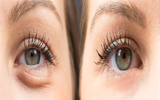 lower eyelid laser blepharoplasty