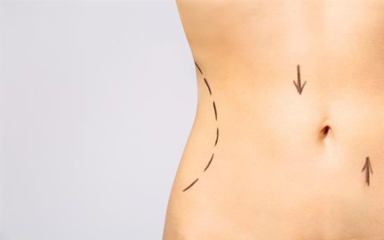 liposuction or tummy tuck