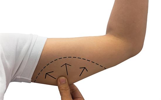 arm liposuction or brachioplasty