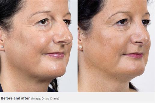 ultrasonic rhinoplasty