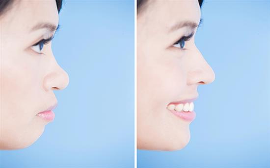 chin implant and rhinoplasty