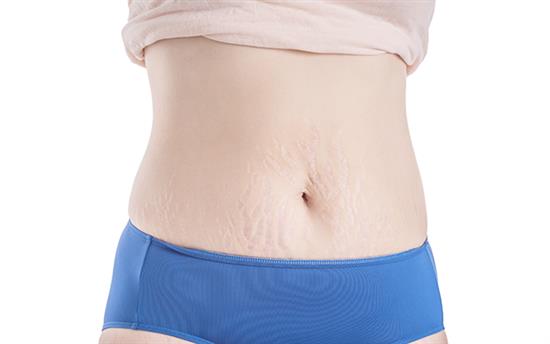 post-pregnancy tummy tuck