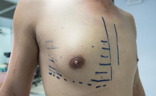 gynaecomastia correction