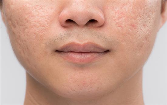 acne scarring