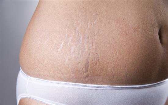 stretch marks