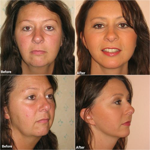 Mini-facelift in 40 year old by Jag Chana